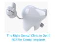 Right Dental Clinic For Dental Implants PowerPoint PPT Presentation