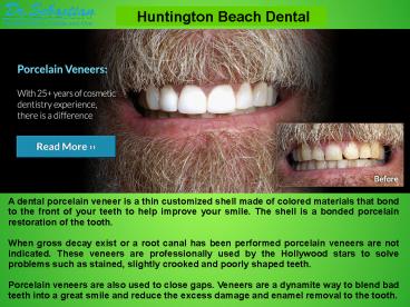 Porcelain Veneers in Huntington Beach Dental Office