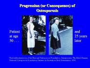 Pathogenesis of Osteoporotic Fracture