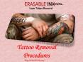 Tattoo Removal Procedures PowerPoint PPT Presentation