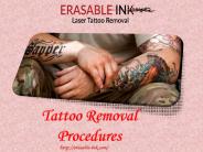 Tattoo Removal Procedures