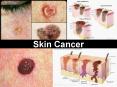 Skin Cancer PowerPoint PPT Presentation