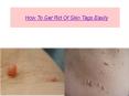 How To Get Rid Of Skin Tags Easily PowerPoint PPT Presentation
