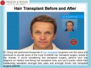 Aesthetic Hair Surgery