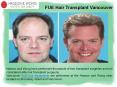 FUE Hair Transplant in Vancouver   PowerPoint PPT Presentation