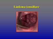Linfoma tonsillare