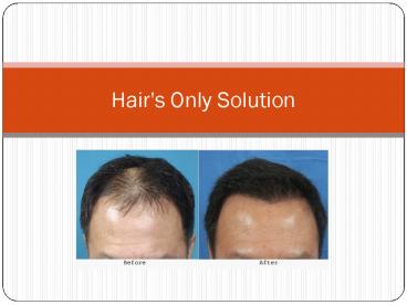 Hair Transplant clinic-20% off on special treatments(9650 708899)