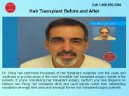 Hair Transplant Clinic in Vancouver PowerPoint PPT Presentation