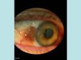 Local conjunctival mets (LCMs) in 7 cases. PowerPoint PPT Presentation