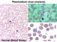 Plasmodium vivax (malaria) PowerPoint PPT Presentation