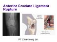 Anterior Cruciate Ligament  Rupture PowerPoint PPT Presentation