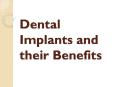 Dental Implants and their Benefits PowerPoint PPT Presentation