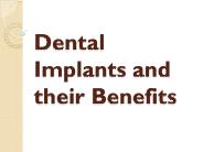 Dental Implants and their Benefits