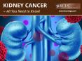 Cancer of the Kidney - What You Need to Know! PowerPoint PPT Presentation