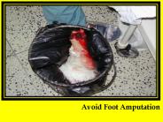Natural Foot Gangrene Treatment (2)