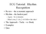ECG Tutorial: Rhythm Recognition