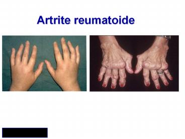 Artrite%20reumatoide