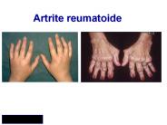 Artrite%20reumatoide