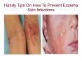 Handy Tips On How To Prevent Eczema Skin Infections PowerPoint PPT Presentation