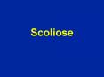 Scoliose PowerPoint PPT Presentation