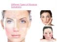 Different Types of Rosacea Symptoms PowerPoint PPT Presentation