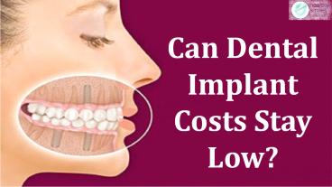 Can Dental Implant Costs Stay Low?