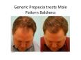 Generic Propecia treats Male Pattern Baldness