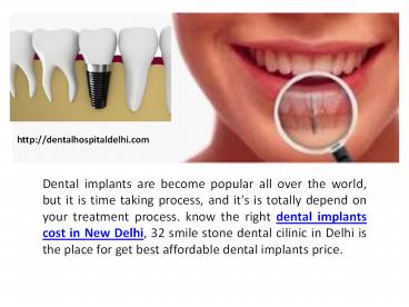 Suitable Dental Implants Cost in New Delhi
