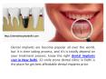 Suitable Dental Implants Cost in New Delhi PowerPoint PPT Presentation