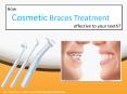 How is Cosmetic Braces treatment effective to your teeth? PowerPoint PPT Presentation