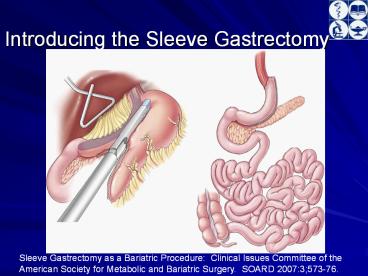 Introducing%20the%20Sleeve%20Gastrectomy