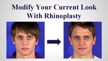 Modify Your Current Look With Rhinoplasty