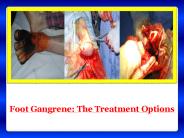 Foot Gangrene: The Treatment Options