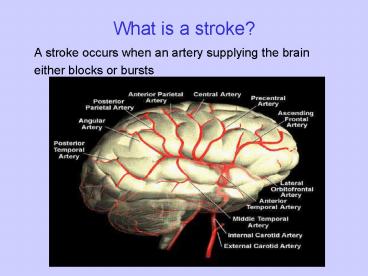 What is a stroke?