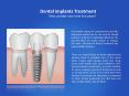 Dental Implants Treatment: Why consider one in the first place? PowerPoint PPT Presentation