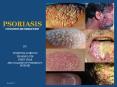 PSORIASIS ETIOPATOGENESIS AND PHARMACOTHERAPY PowerPoint PPT Presentation