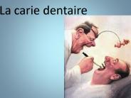 La carie dentaire