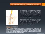 The Ultimate Guide to Root Canal Treatment
