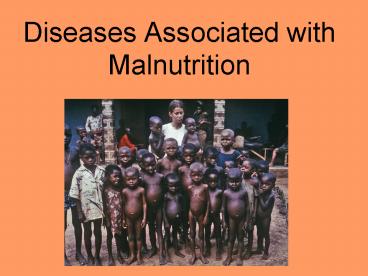 Diseases Associated with Malnutrition