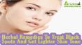 Herbal Remedies To Treat Black Spots And Get Lighter Skin Tone