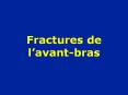 Fractures de l PowerPoint PPT Presentation
