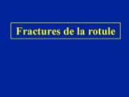 Fractures de la rotule