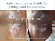 Safe treatment available for Vitiligo and Leucoderma