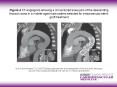 Figure 4 CT-angiogram showing a circumscript aneurysm of the descending thoracic aorta in a middle-aged male patient selected for endovascular stent-graft treatment PowerPoint PPT Presentation