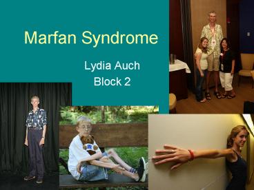 Marfan Syndrome