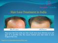 Hair Loss Treatment in India PowerPoint PPT Presentation