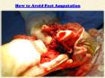 How to Avoid Foot Amputation PowerPoint PPT Presentation