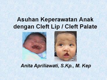 Asuhan Keperawatan Anak dengan Cleft Lip / Cleft Palate