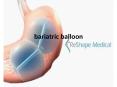 stomach balloon