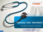 varicose vein Treatment